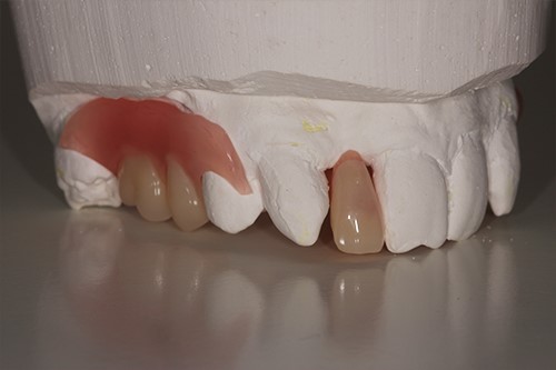 New Dentures What To Expect Alapaha GA 31622